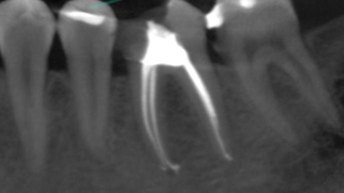 Skuteczność leczenia kanałowego - przykłady z naszego leczenia Skuteczność leczenia kanałowego - przykłady z naszego leczenia