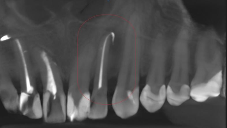 Skuteczność leczenia kanałowego - przykłady z naszego leczenia Skuteczność leczenia kanałowego - przykłady z naszego leczenia