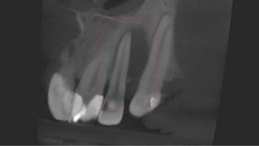 Skuteczność leczenia kanałowego - przykłady z naszego leczenia Skuteczność leczenia kanałowego - przykłady z naszego leczenia