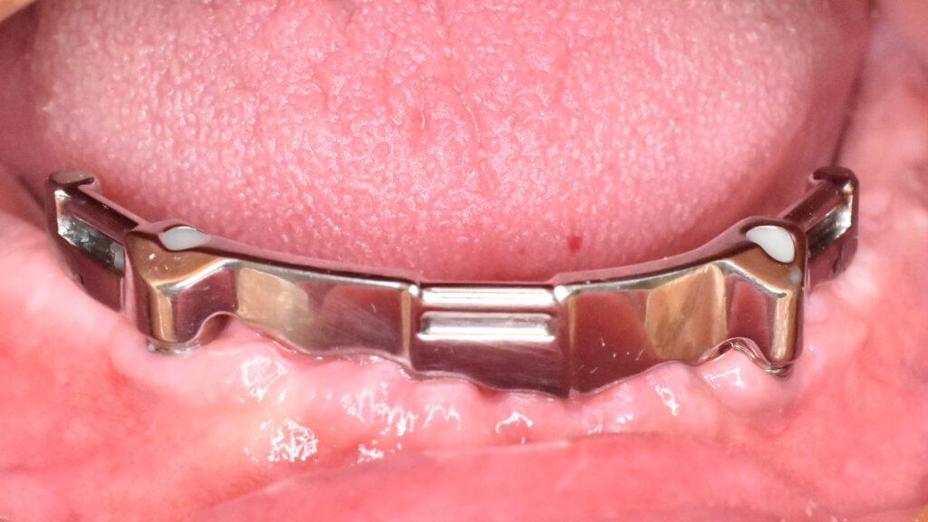 protezy zębowe na implantach Jastrzębie Zdrój Protezy na implantach