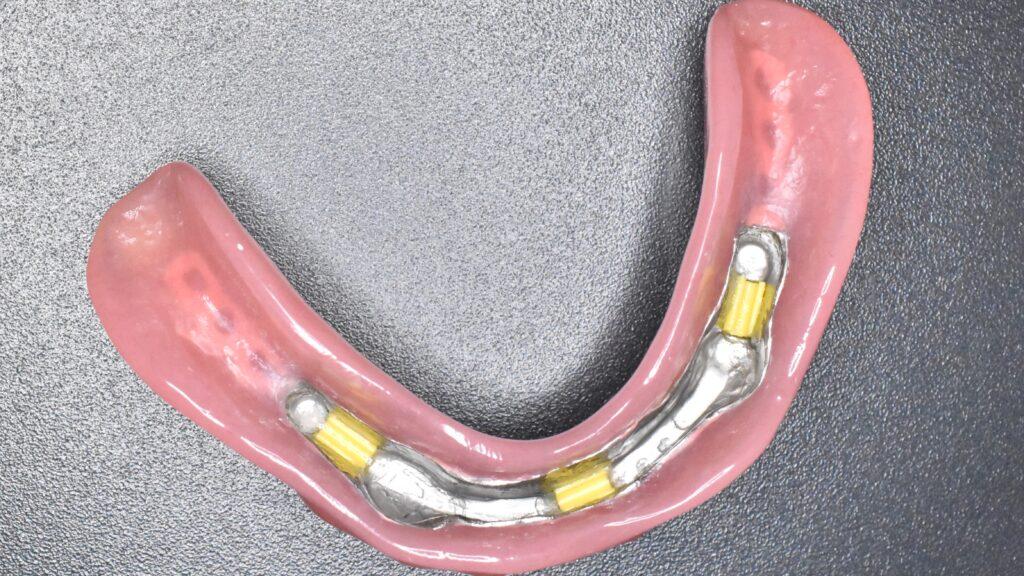 protezy zębowe na implantach Jastrzębie Zdrój Protezy na implantach