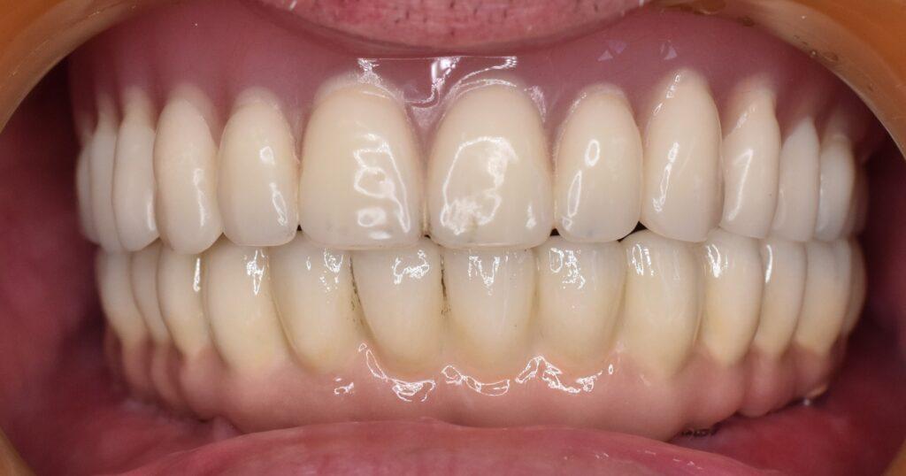 protezy zębowe na implantach Jastrzębie Zdrój Protezy na implantach