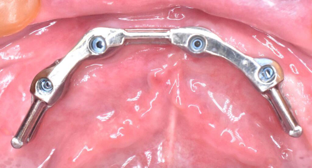 protezy zębowe na implantach Jastrzębie Zdrój Protezy na implantach