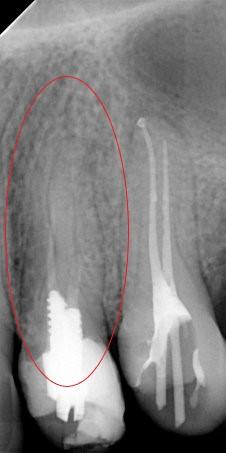 Skuteczność leczenia kanałowego - przykłady z naszego leczenia Skuteczność leczenia kanałowego - przykłady z naszego leczenia