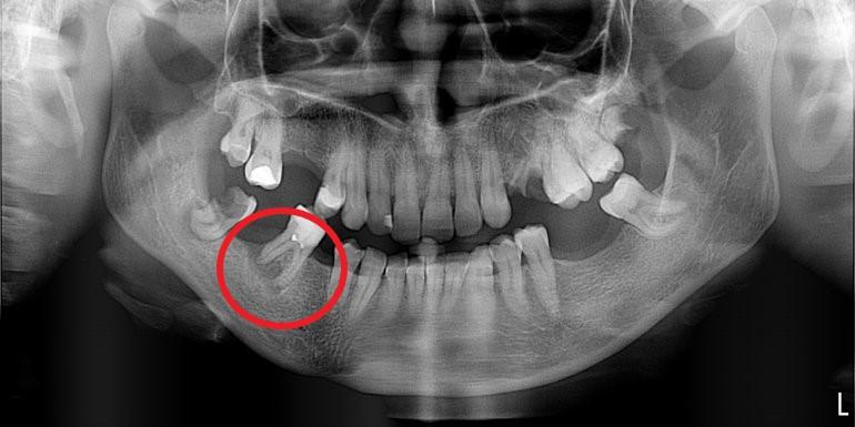 Skuteczność leczenia kanałowego - przykłady z naszego leczenia Skuteczność leczenia kanałowego - przykłady z naszego leczenia