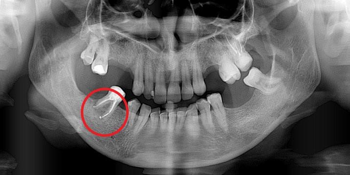 Skuteczność leczenia kanałowego - przykłady z naszego leczenia Skuteczność leczenia kanałowego - przykłady z naszego leczenia