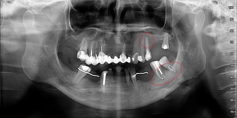Skuteczność leczenia kanałowego - przykłady z naszego leczenia Skuteczność leczenia kanałowego - przykłady z naszego leczenia
