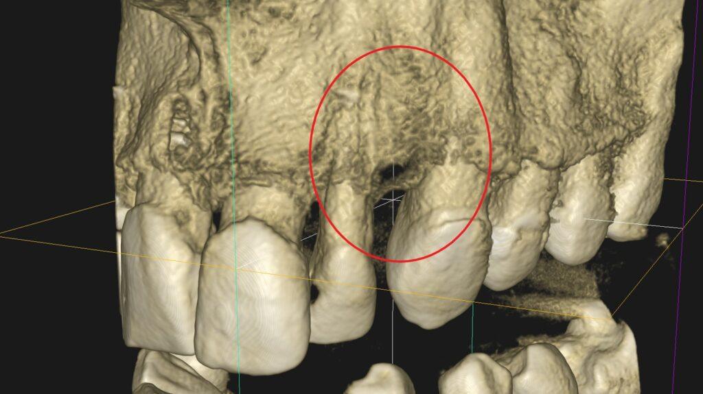 Skuteczność leczenia kanałowego - przykłady z naszego leczenia Skuteczność leczenia kanałowego - przykłady z naszego leczenia