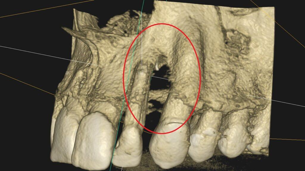 Skuteczność leczenia kanałowego - przykłady z naszego leczenia Skuteczność leczenia kanałowego - przykłady z naszego leczenia