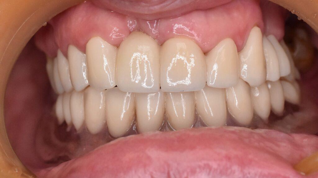 Metamorfozy protetyczne naszych Pacjentów Metamorfozy protetyczne naszych Pacjentów